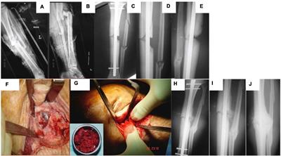 Systematic Review of the Preclinical Technology Readiness of Orthopedic Gene Therapy and Outlook for Clinical Translation